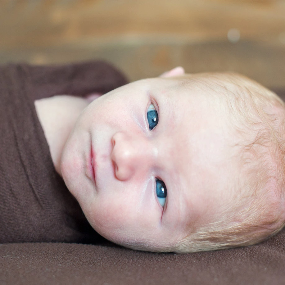Bebê com estrabismo convergente (olho desviado para dentro).