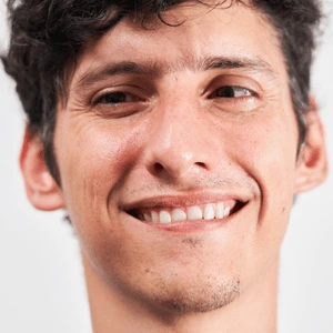 Falso estrabismo: os olhos parecem desalinhados, mas exames comprovam que estão normais.